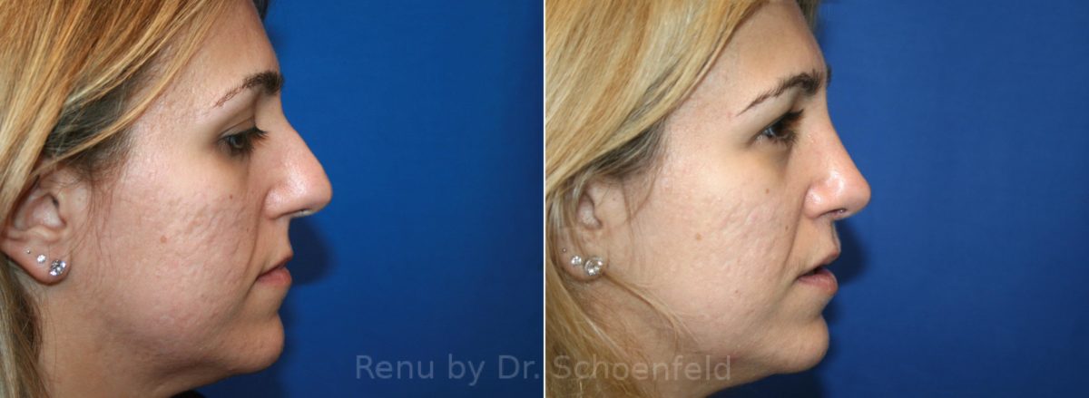 Rhinoplasty Before and After Photos in DC, Patient 12961