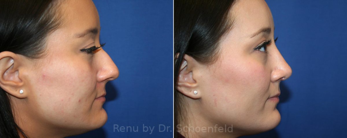Rhinoplasty Before and After Photos in DC, Patient 13062
