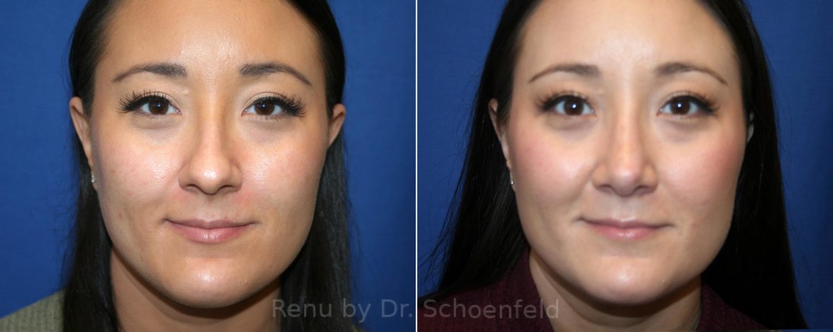 Rhinoplasty Before and After Photos in DC, Patient 13062