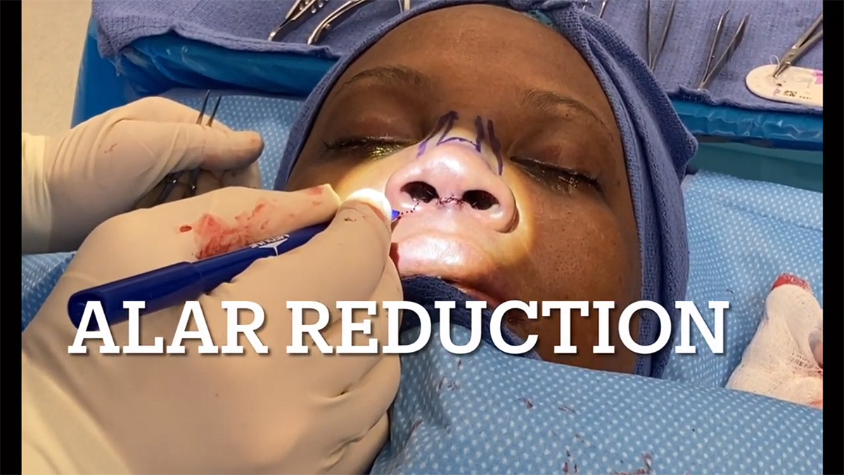 Alar Reduction