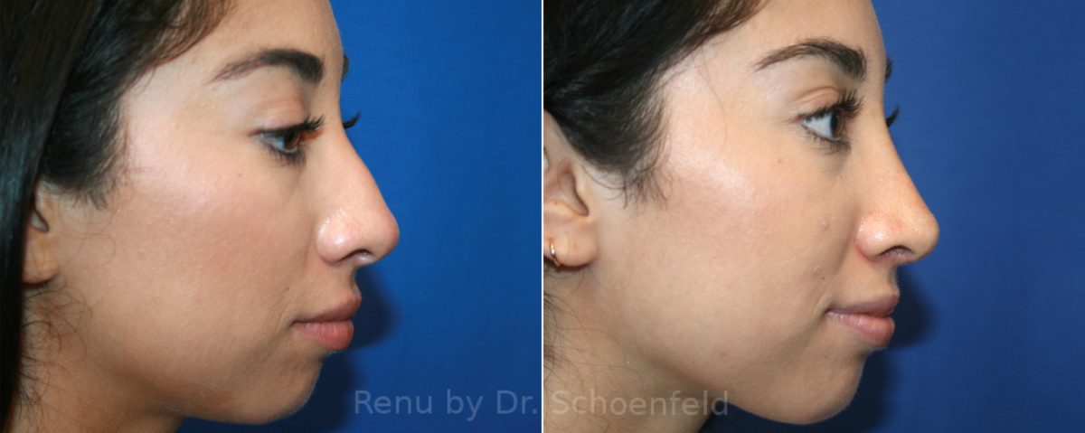 Rhinoplasty Before and After Photos in DC, Patient 13123