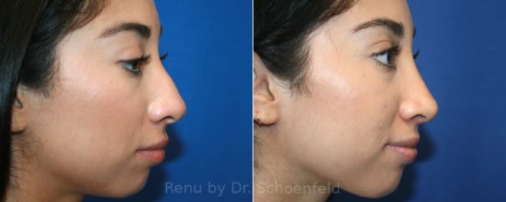 Rhinoplasty Before and After Photos in Chevy Chase, MD