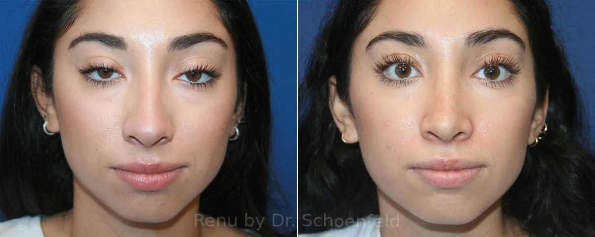 Patient 13123, Rhinoplasty Before and After Photos Rhinoplasty Before and After Photos in DC, Patient 13123