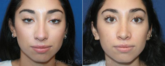 Rhinoplasty Before and After Photos in , 
