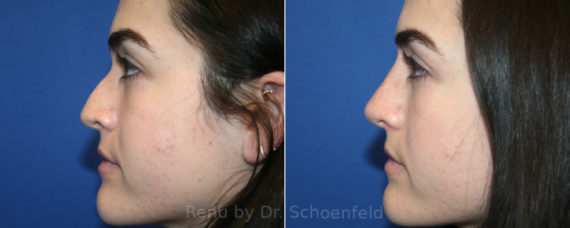 Non-Surgical Rhinoplasty Before and After Photos in DC, Patient 13231