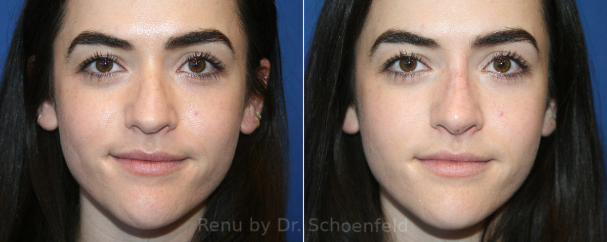 Non-Surgical Rhinoplasty Before and After Photos in DC, Patient 13231