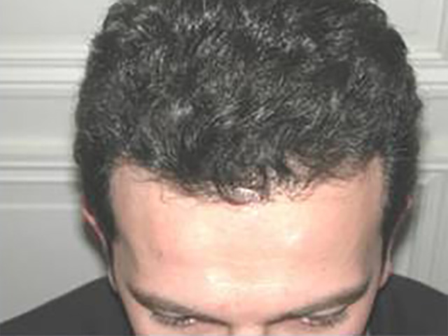 Before NeoGraft Hair Restoration photo