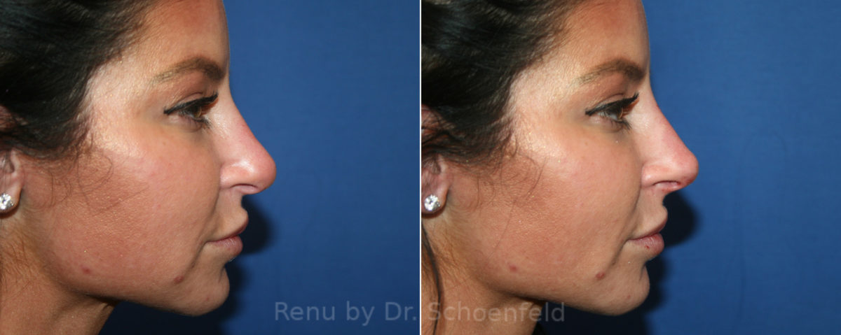 Non-Surgical Rhinoplasty Before and After Photos in DC, Patient 13331