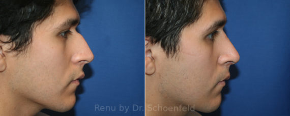 Rhinoplasty Before and After Photos in DC, Patient 13335