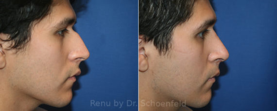 Rhinoplasty Before and After Photos in DC, Patient 13335
