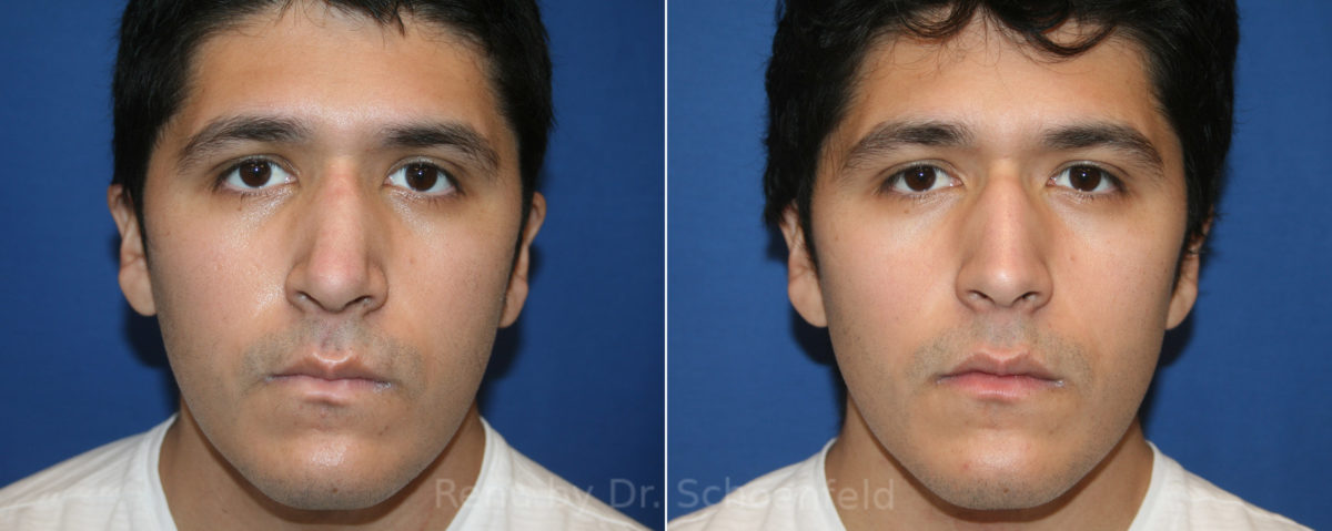 Rhinoplasty Before and After Photos in DC, Patient 13335