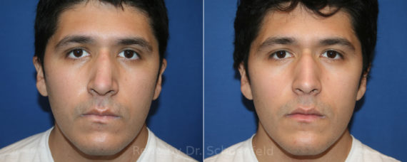 Rhinoplasty Before and After Photos in DC, Patient 13335