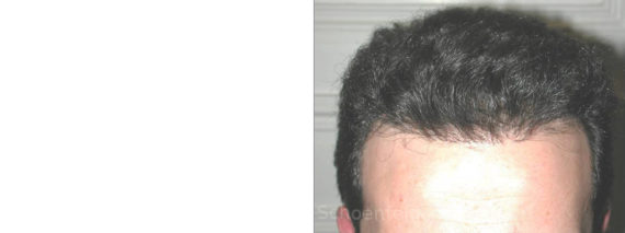 NeoGraft Hair Restoration Before and After Photos in DC, Patient 13360