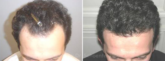 NeoGraft Hair Restoration Before and After Photos in Chevy Chase, MD