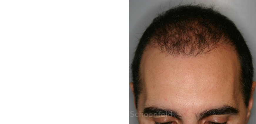 NeoGraft Hair Restoration Before and After Photos in DC, Patient 13371