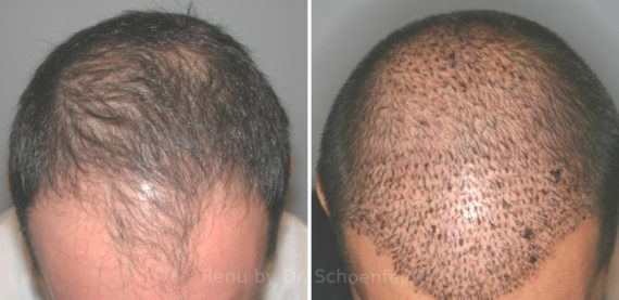 NeoGraft Hair Restoration Before and After Photos in DC, Patient 13371