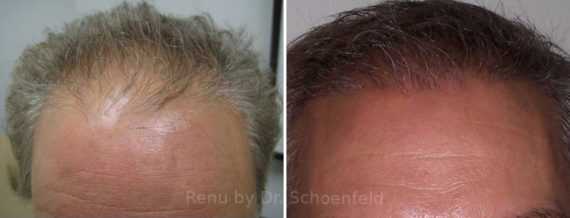 NeoGraft Hair Restoration Before and After Photos in DC, Patient 13375