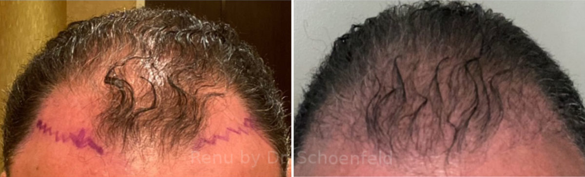 NeoGraft Hair Restoration Before and After Photos in DC, Patient 13379