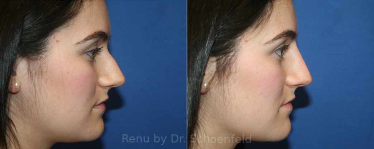 Non-Surgical Rhinoplasty Before and After Photos in DC, Patient 13399