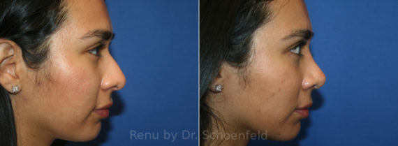 Rhinoplasty Before and After Photos in DC, Patient 13404