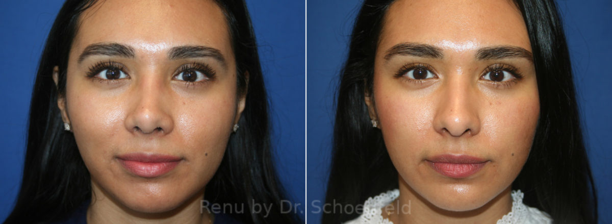 Rhinoplasty Before and After Photos in DC, Patient 13404