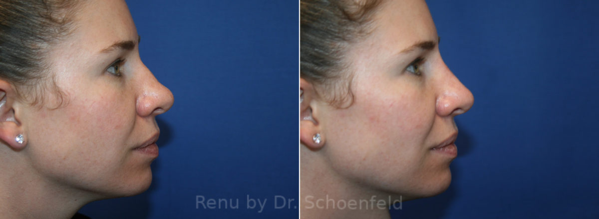 Non-Surgical Rhinoplasty Before and After Photos in DC, Patient 13424