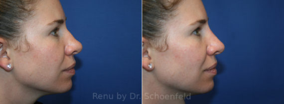 Non-Surgical Rhinoplasty Before and After Photos in DC, Patient 13424