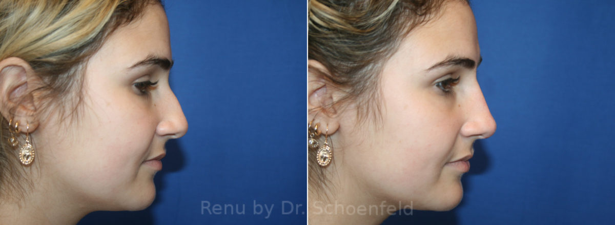 Non-Surgical Rhinoplasty Before and After Photos in DC, Patient 13425