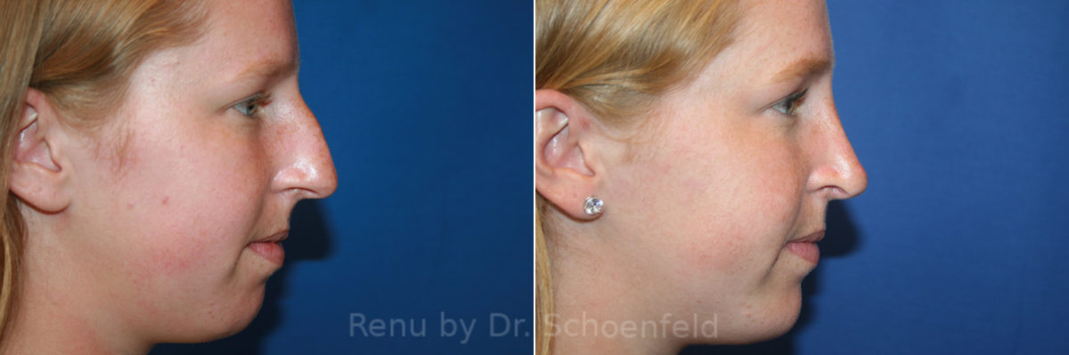 Rhinoplasty Before and After Photos in DC, Patient 13438