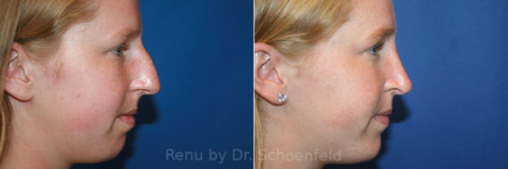 Chin Implant Before and After Photos in DC, Patient 13438