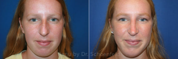 Chin Implant Before and After Photos in DC, Patient 13438