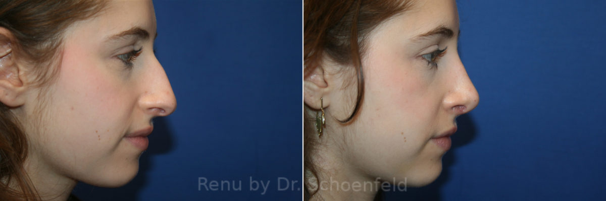 Rhinoplasty Before and After Photos in DC, Patient 13514