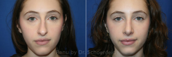 Rhinoplasty Before and After Photos in DC, Patient 13514