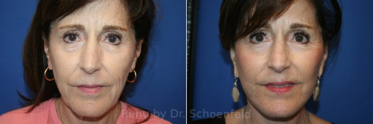 Facelift Before and After Photos in DC, Patient 13548