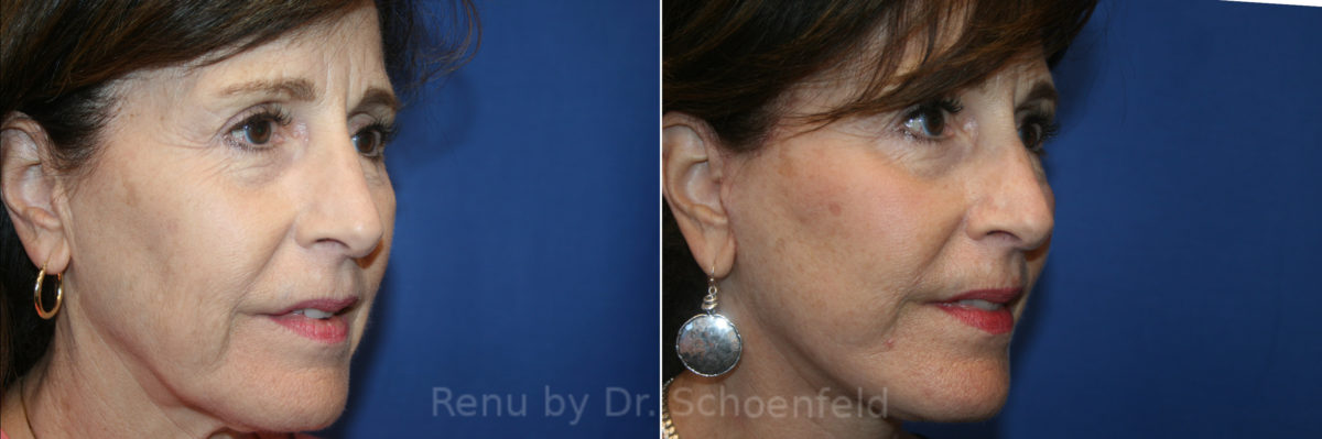 Facelift Before and After Photos in DC, Patient 13548