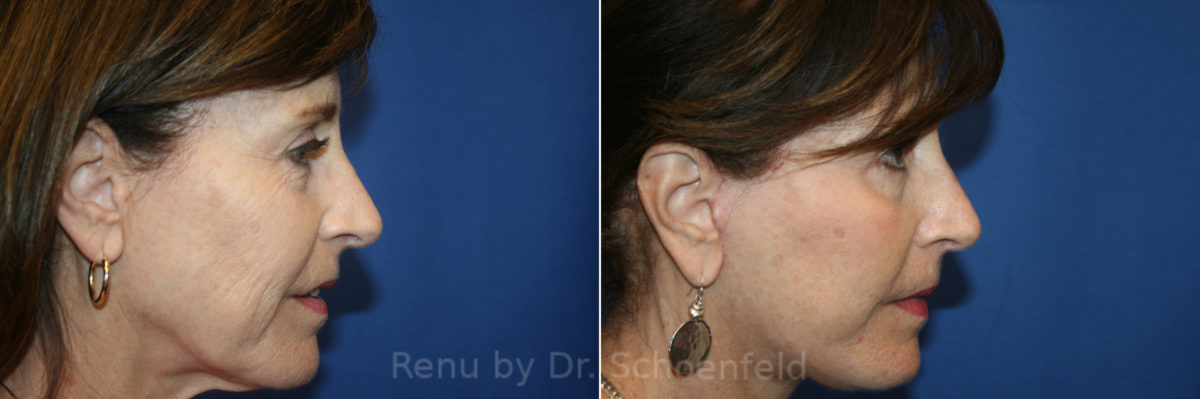 Facelift Before and After Photos in DC, Patient 13548