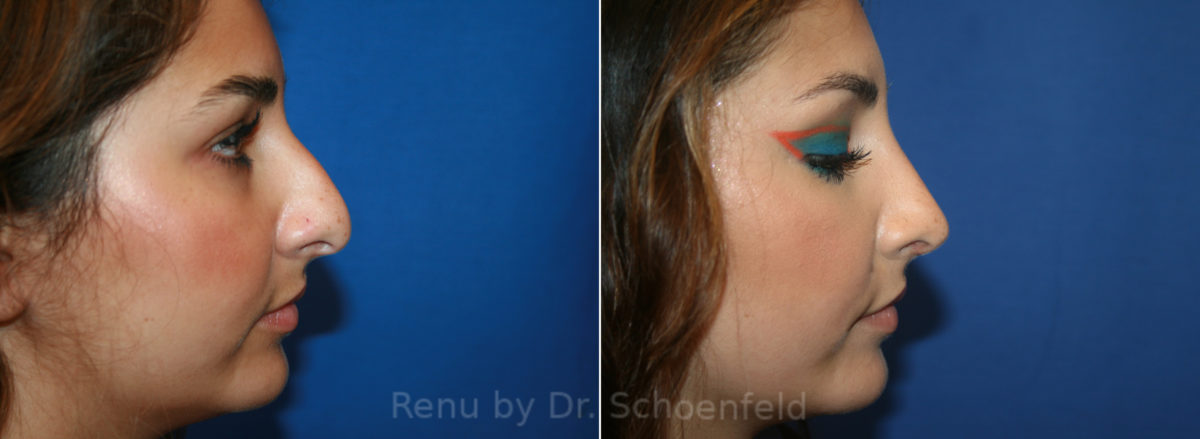 Rhinoplasty Before and After Photos in DC, Patient 13558