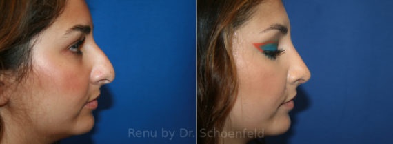 Rhinoplasty Before and After Photos in DC, Patient 13558