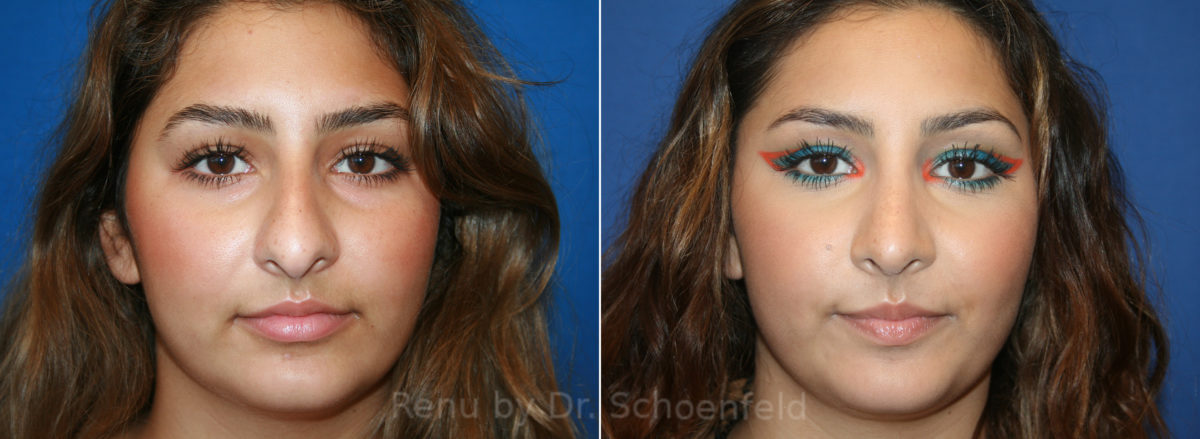 Patient 13558, Rhinoplasty Before and After Photos Rhinoplasty Before and After Photos in DC, Patient 13558