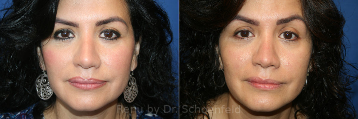 Rhinoplasty Before and After Photos in DC, Patient 13565