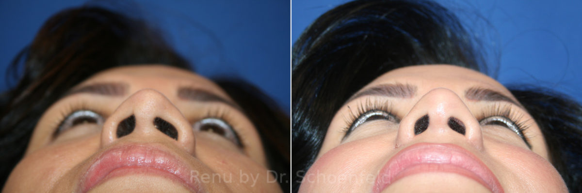 Rhinoplasty Before and After Photos in DC, Patient 13565