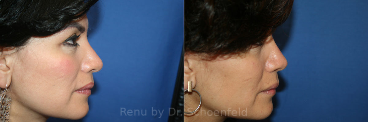 Rhinoplasty Before and After Photos in DC, Patient 13565