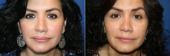 Rhinoplasty Before and After Photos in DC, Patient 13565