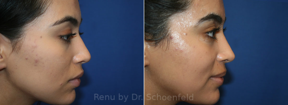 Rhinoplasty Before and After Photos in DC, Patient 13608