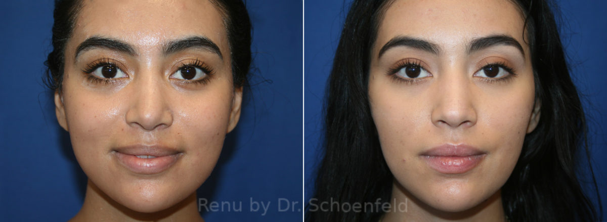 Rhinoplasty Before and After Photos in DC, Patient 13608