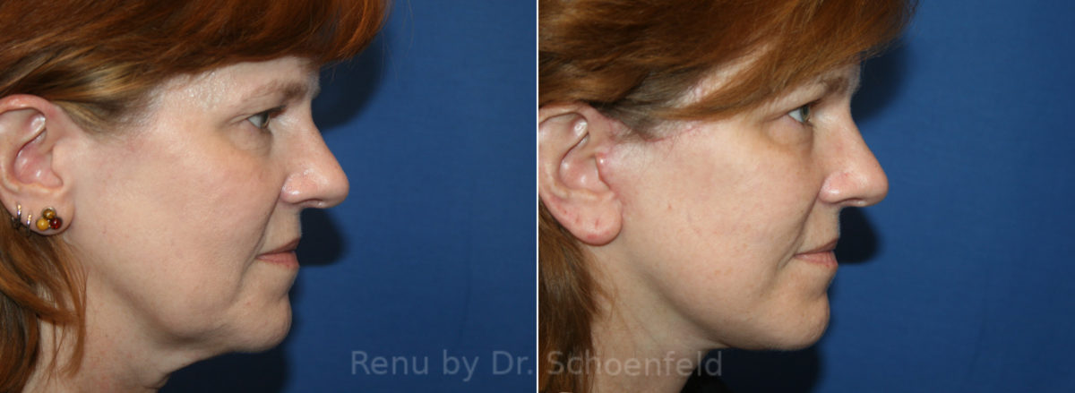 Patient 13616, Facelift Before and After Photos Facelift Before and After Photos in DC, Patient 13616