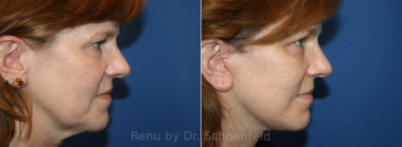 Facelift Before and After Photos in DC, Patient 13616