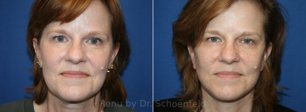 Patient 13616, Facelift Before and After Photos Facelift Before and After Photos in DC, Patient 13616