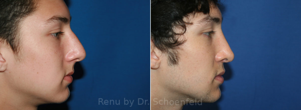 Rhinoplasty Before and After Photos in DC, Patient 13626