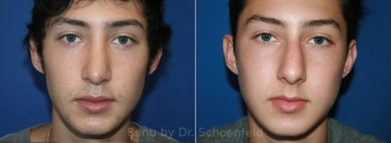 Rhinoplasty Before and After Photos in DC, Patient 13626